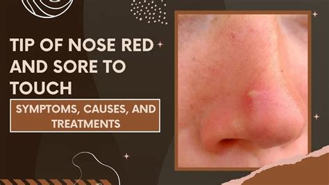 A bacterial infection of the <b>nose</b> <b>and</b> sinuses, particularly of the ethmoid sinuses, is more likely to cause nasal pain especially when it is severe. . Tip of nose red and sore to touch